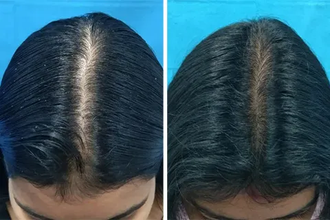 Hair rejuvation therapy before photo in VCare